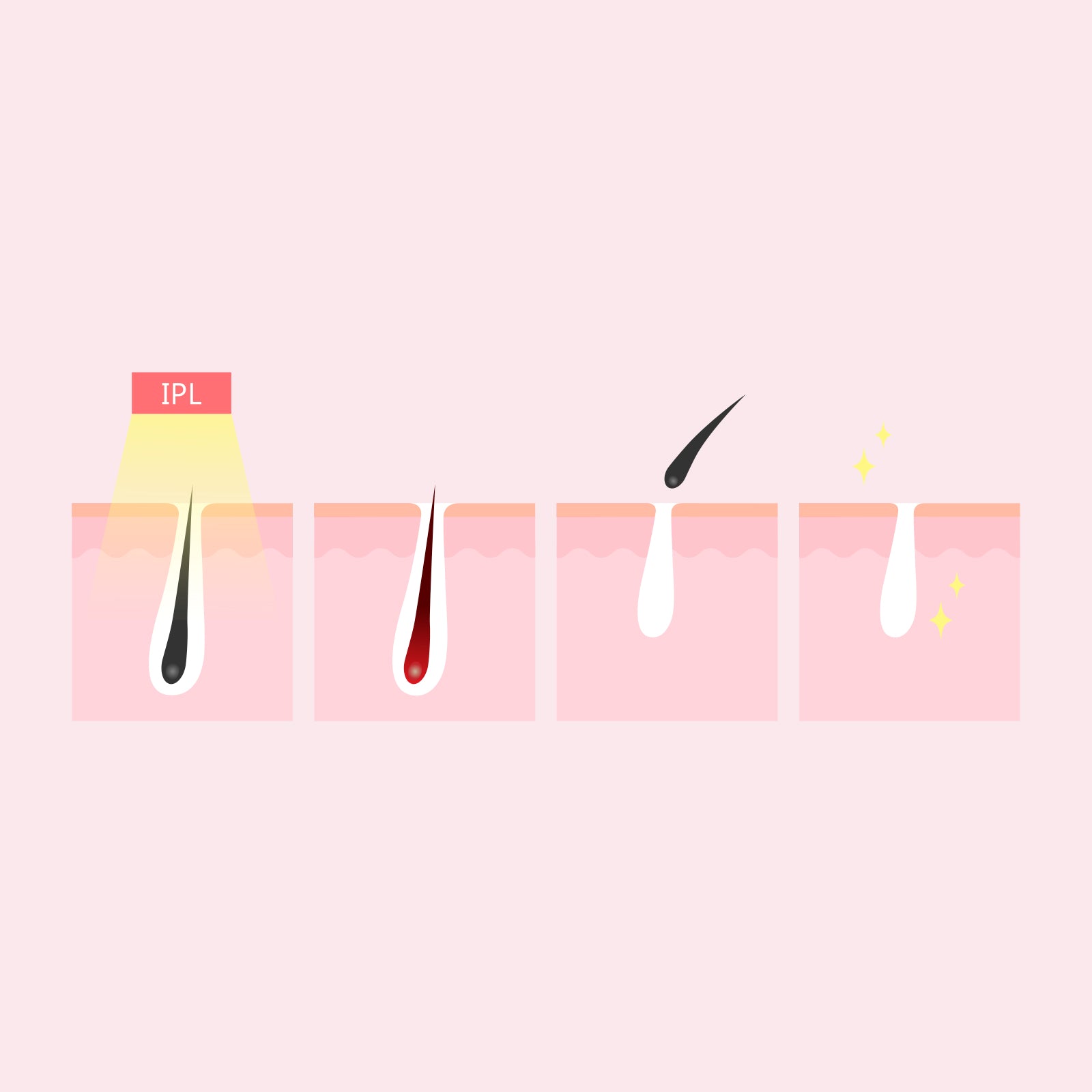 Silhouette Portable Laser Hair Remover Permanent Epliation System Body Face Home 11