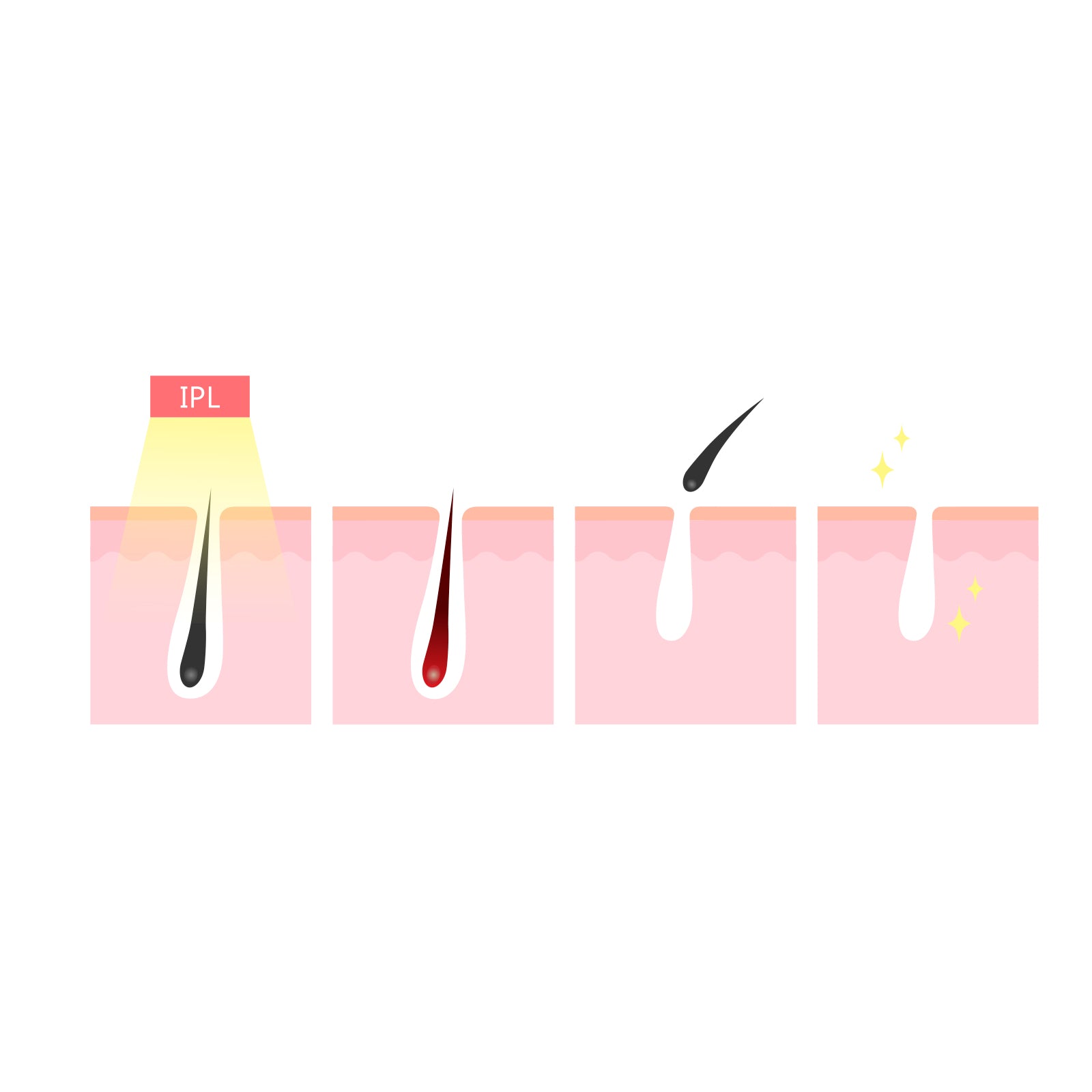 Silhouette Portable Laser Hair Remover Permanent Epliation System Body Face Home 15