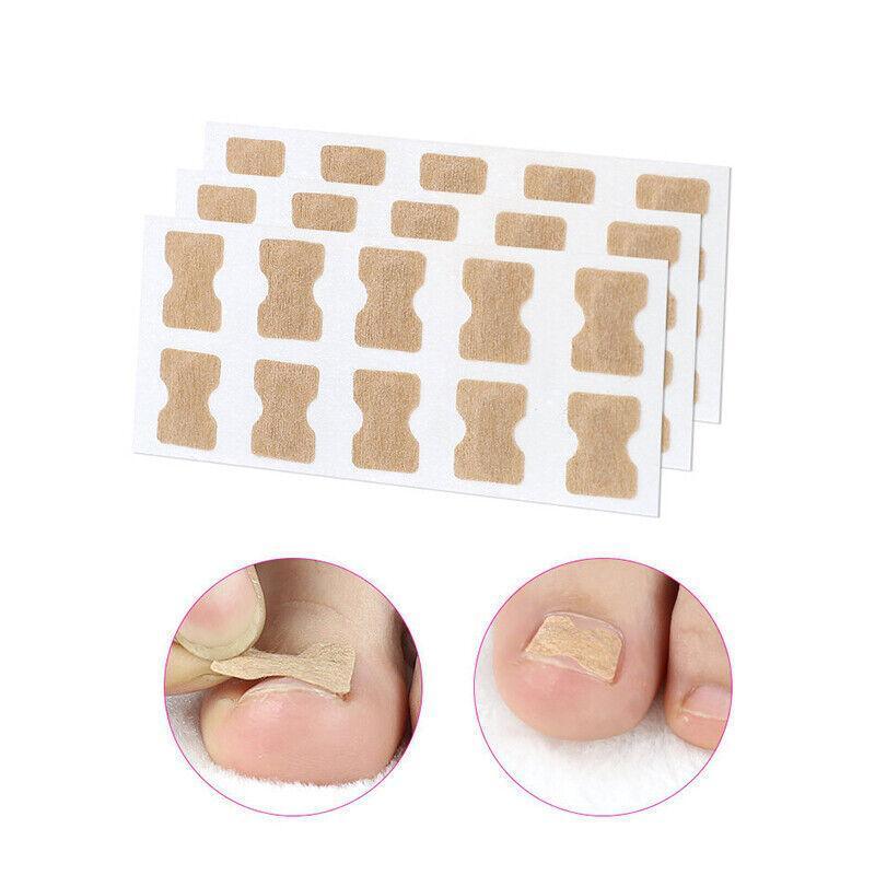 50-100Pcs Glue Free Toenail Toe Ingrown Nail Correction Patch Sticker Foot Care - 50PCS 3