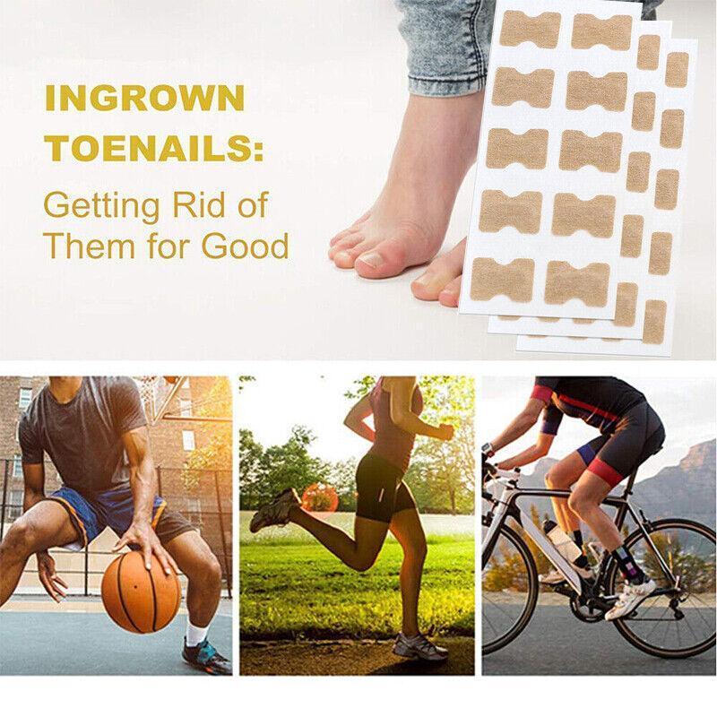 50-100Pcs Glue Free Toenail Toe Ingrown Nail Correction Patch Sticker Foot Care - 50PCS 4