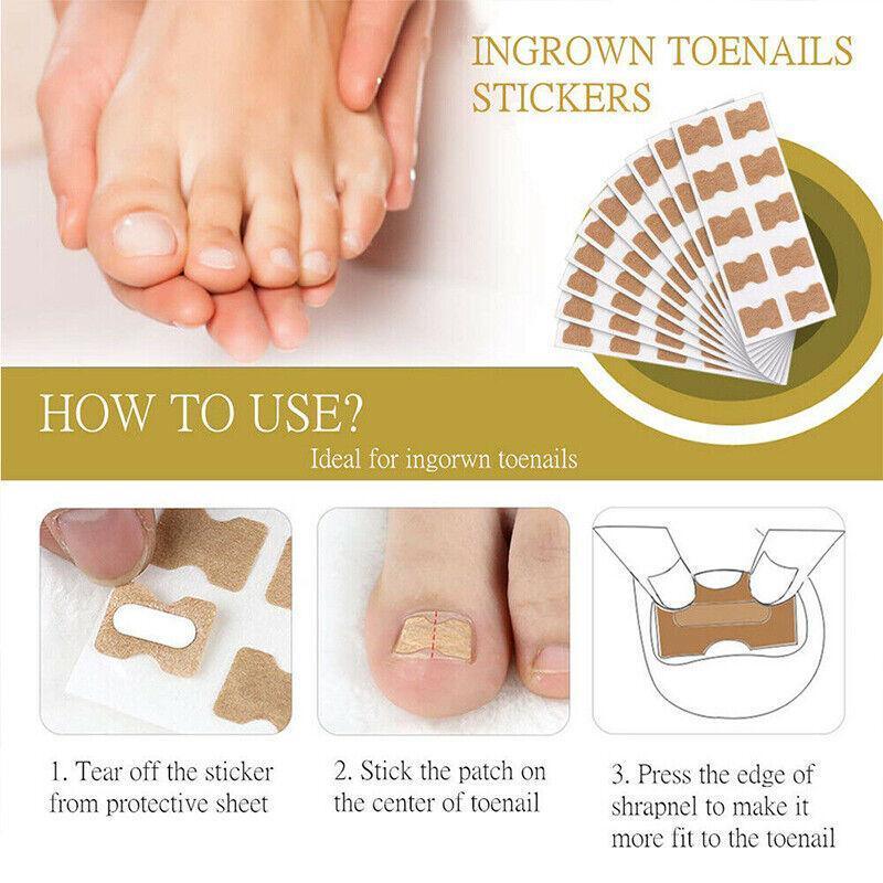 50-100Pcs Glue Free Toenail Toe Ingrown Nail Correction Patch Sticker Foot Care - 50PCS 5