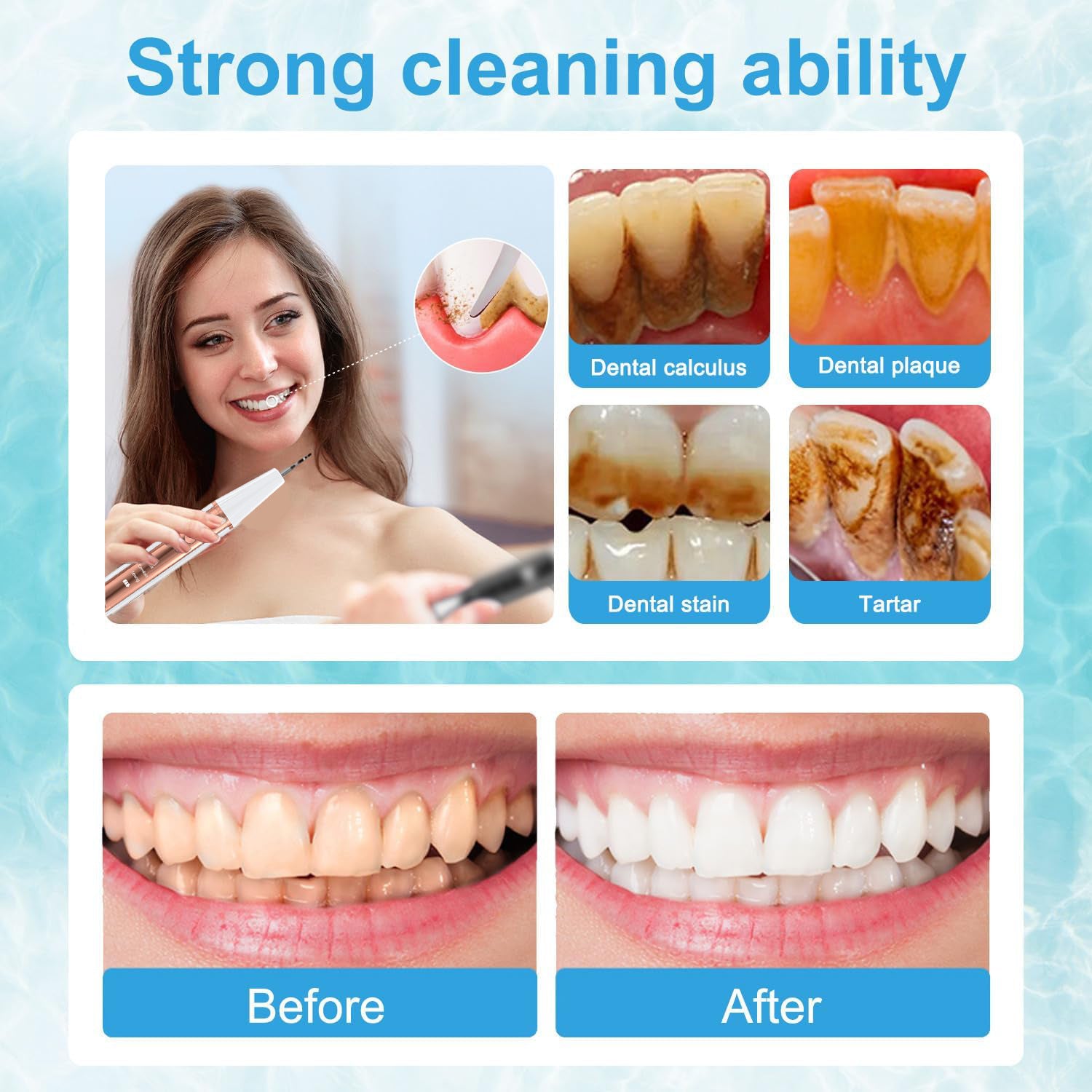 Ultrasonic Dental Scaler Kit - Home Use Teeth Cleaner & Tartar Remover 5