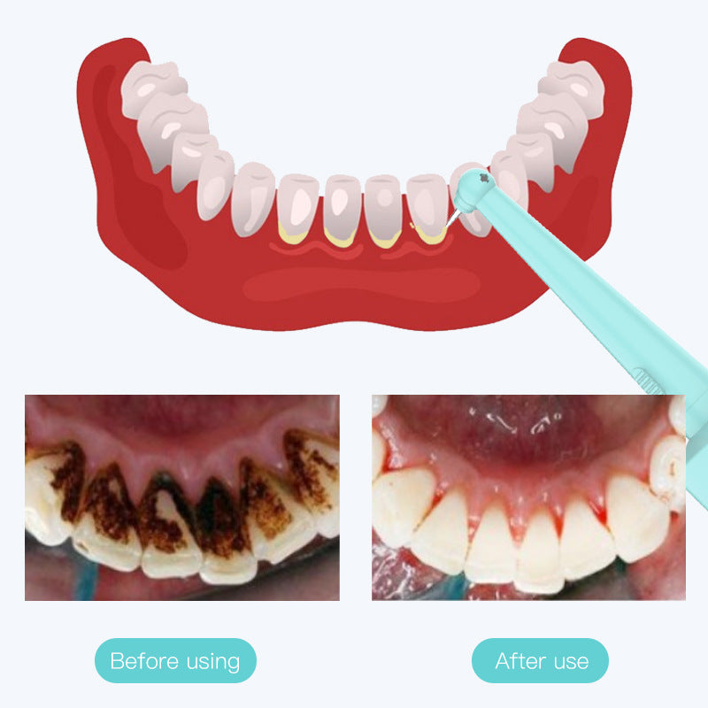 Intelligent High-Frequency Vibration Dental Calculus & Stain Remover(blue) 5